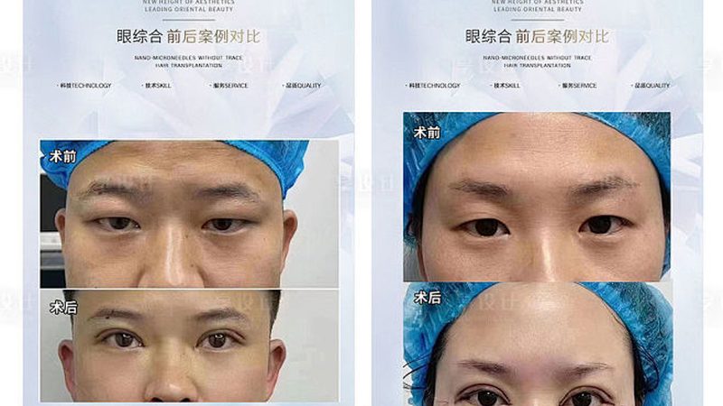 玻尿酸与肉毒素：面部皱纹的“自然”与“即时”解决方案