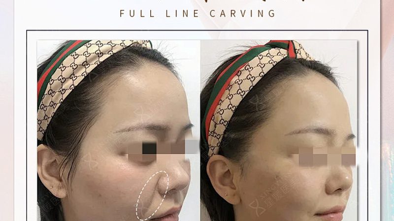西安磨骨手术：揭秘价格背后的考量因素**