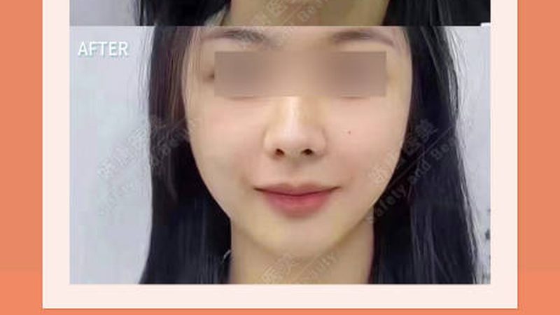 小标题：割双眼皮，常见误区盘点