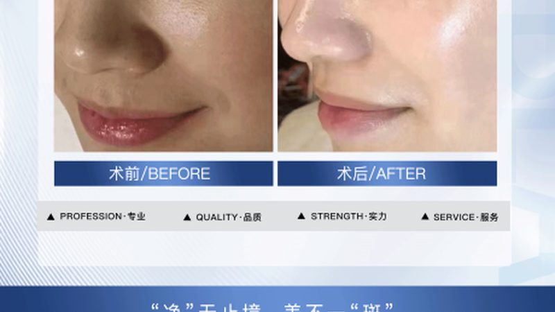 隆鼻术后恢复：揭秘全过程与关键期