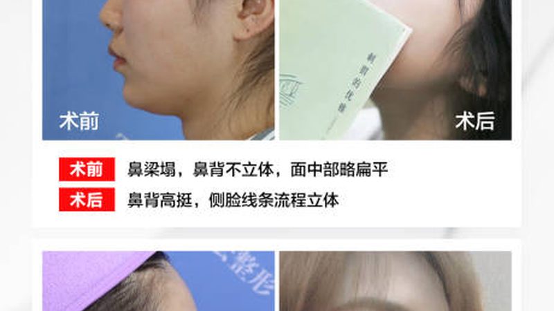 永久脱毛，真的有效吗？揭秘脱毛技术的真相**