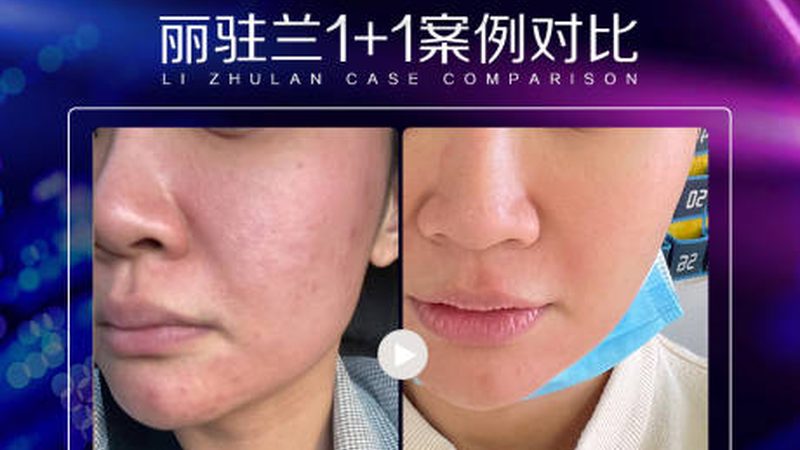 口服玻尿酸代理加盟，你了解多少？**