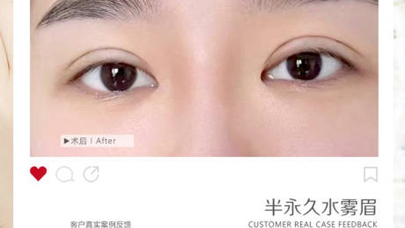 下颌角截骨术后恢复期揭秘：了解真相，安心蜕变