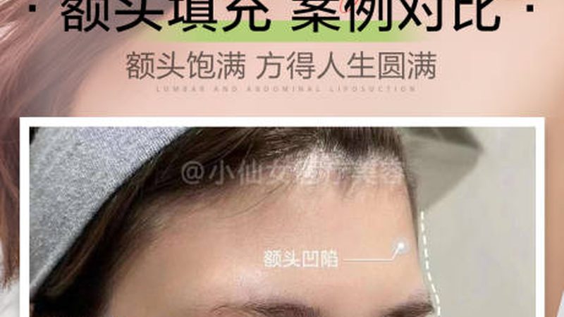 埋线提升适合年轻女生做吗